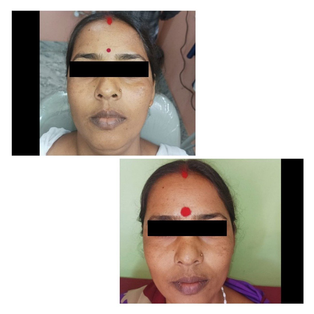 glutathione treatment for skin whitening